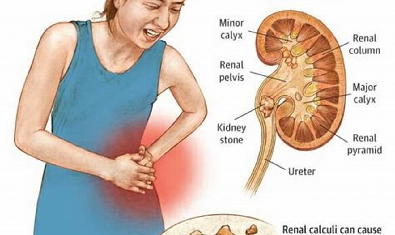 cara mengatasi batu ginjal saat kumat